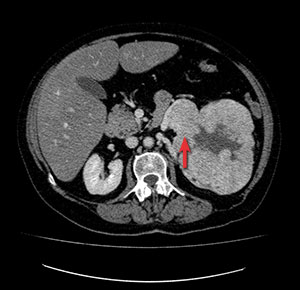 Bilde 7: Preoperativ CT som demonstrerer at tumor hvelver seg over nyrearterien. 